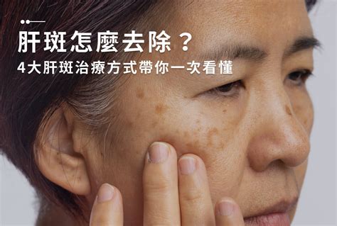 斑的位置|淡斑怎麼做？帶你認識斑點類型、7大長斑原因、6大淡。